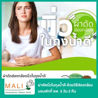 ผ่าตัดนิ่วในถุงน้ำดี ด้วยวิธีส่องกล้อง (Laparoscopic Cholecystectomy) นอนพักที่ รพ. 3 วัน 2 คืน