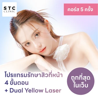 โปรแกรมรักษาสิวทั่วใบหน้า 4 ขั้นตอน รวมเลเซอร์ Dual Yellow ทั่วใบหน้า 4 ครั้ง ฟรี! 1 ครั้ง