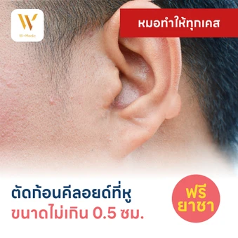ตัดก้อนคีลอยด์ที่หู ขนาดเส้นผ่านศูนย์กลางไม่เกิน 0.5 ซม. 1 จุด 1 ครั้ง