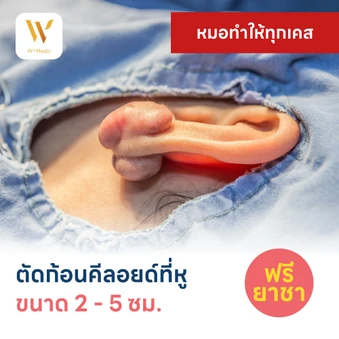 ตัดก้อนคีลอยด์ที่หู ขนาดเส้นผ่านศูนย์กลาง 2-5 ซม. 1 จุด 1 ครั้ง