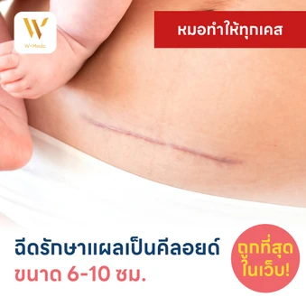ฉีดรักษาแผลเป็นคีลอยด์ ขนาดเส้นผ่านศูนย์กลาง 6-10 ซม. 1 จุด 1 ครั้ง
