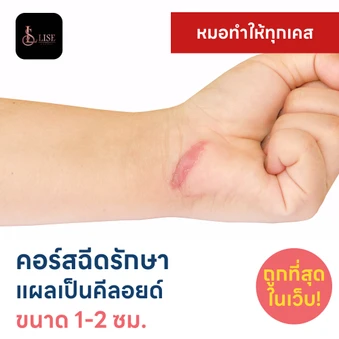 คอร์สฉีดรักษาแผลเป็นคีลอยด์ ขนาดเส้นผ่านศูนย์กลาง 1-2 ซม. 1 จุด 5 ครั้ง