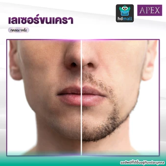 โปรแกรมเลเซอร์กำจัดขนเครา 1 ครั้ง (ราคาทดลอง 1 สิทธิ์/ท่าน)