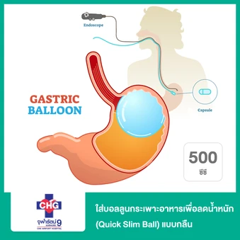 ใส่บอลลูนกระเพาะอาหารเพื่อลดน้ำหนัก (Quick Slim Ball) 500 ซีซี แบบกลืน