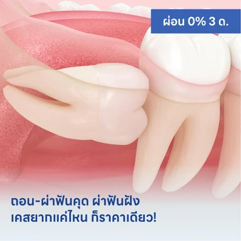 ถอน-ผ่าฟันคุด ผ่าฟันฝัง เคสยากแค่ไหน ก็ราคาเดียว!