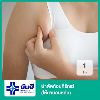 ผ่าตัดก้อนที่รักแร้ 1 ข้าง (ให้ยานอนหลับ)