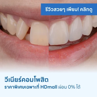 ทำวีเนียร์คอมโพสิต ฟันสวยได้ ไม่ต้องจ่ายแพง ราคาพิเศษเฉพาะที่ HDmall