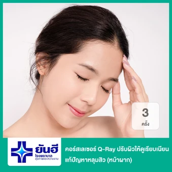 คอร์สเลเซอร์ Q-Ray ปรับผิวให้ดูเรียบเนียน แก้ปัญหาหลุมสิว 3 ครั้ง (หน้าผาก)