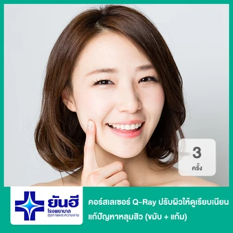 คอร์สเลเซอร์ Q-Ray ปรับผิวให้ดูเรียบเนียน แก้ปัญหาหลุมสิว 3 ครั้ง (ขมับ + แก้ม)