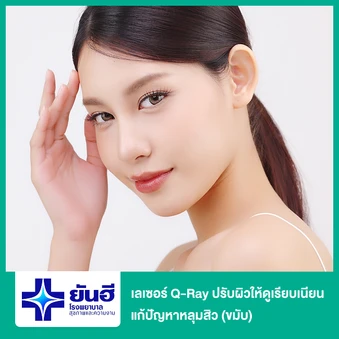 เลเซอร์ Q-Ray ปรับผิวให้ดูเรียบเนียน แก้ปัญหาหลุมสิว (ขมับ)