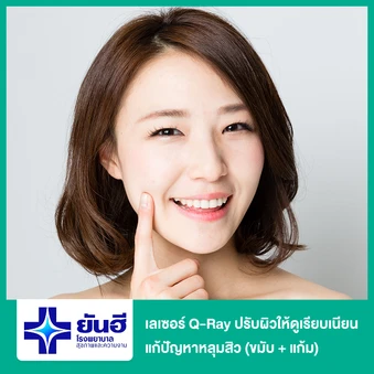 เลเซอร์ Q-Ray ปรับผิวให้ดูเรียบเนียน แก้ปัญหาหลุมสิว (ขมับ + แก้ม)