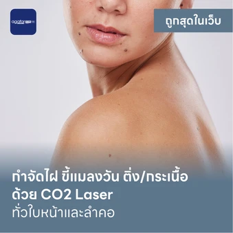 กำจัดไฝ ขี้แมลงวัน ติ่งเนื้อ กระเนื้อ ด้วย CO2 Laser ขนาดเส้นผ่านศูนย์กลางไม่เกิน 2 มม. ไม่จำกัดจุดทั่วใบหน้าและลำคอ 1 ครั้ง