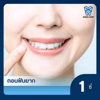 ถอนฟันอย่างยาก 1 ซี่