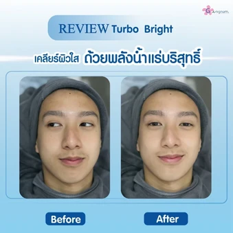 ทำทรีตเมนต์หน้า Turbo Bright ปรับสภาพผิวให้ดูกระจ่างใส 1 ครั้ง