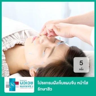 โปรแกรมฝังเข็มแผนจีน หน้าใส รักษาสิว 5 ครั้ง