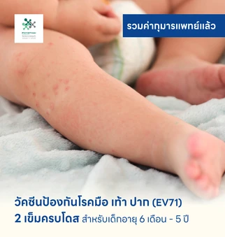 วัคซีนป้องกันโรคมือ เท้า ปาก 2 เข็ม (ครบโดส) สำหรับเด็กอายุ 6 เดือน-5 ปี