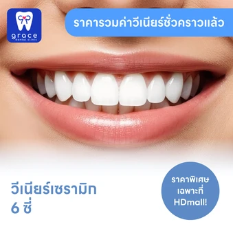 ทำวีเนียร์เซรามิก E-Max Press 6 ซี่