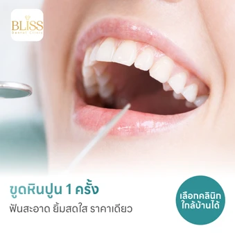 ขูดหินปูน