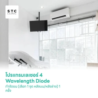 โปรแกรมเลเซอร์ 4 Wavelength Diode กำจัดขน (เลือก 1 จุด หลังบน/หลังล่าง) 1 ครั้ง