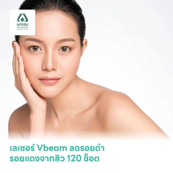 เลเซอร์ Vbeam ลดรอยดำ รอยแดงจากสิว 120 ช็อต
