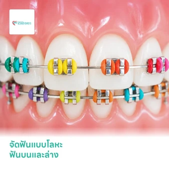 จัดฟันแบบโลหะ ฟันบนและล่าง