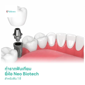 ทำรากฟันเทียม ยี่ห้อ Neo Biotech สำหรับฟัน 1 ซี่