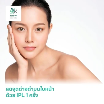 ลดจุดด่างดำบนใบหน้า ด้วย IPL 1 ครั้ง