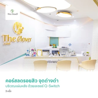 คอร์สลดรอยสิว จุดด่างดำ บริเวณแผ่นหลัง ด้วยเลเซอร์ Q-Switch 3 ครั้ง