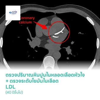 ตรวจปริมาณหินปูนในหลอดเลือดหัวใจ (CT Calcium Score) + ตรวจระดับไขมันในเลือด LDL (40 ปีขึ้นไป)