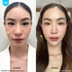 Restylane 2 ซีซี บริเวณร่องแก้ม