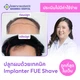 ปลูกผมเทคนิค Implanter FUE Shave