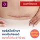 คอร์สฉีดคีลอยด์ 6-10 ซม. 5 ครั้ง