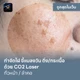CO2 Laser ใบหน้า (BTS ทองหล่อ)