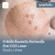 CO2 Laser ใบหน้า (วัชรพล)