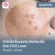 CO2 Laser ใบหน้าหรือลำคอ (บางเขน)