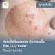 CO2 Laser ใบหน้าหรือลำคอ (MRT สามแยกบางใหญ่)