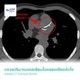 CT Calcium Score เปาโล รังสิต