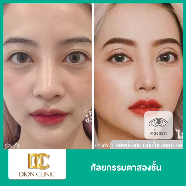 ศัลยกรรมตา 2 ชั้น สำหรับเคสทำครั้งแรก ที่ Dion Clinic - ราคา 2566 (2023) | HDmall ศัลยกรรมตา 2 ชั้น สำหรับเคสทำครั้งแรก ที่ Dion Clinic - ราคา 2566 (2023) | Hdmall