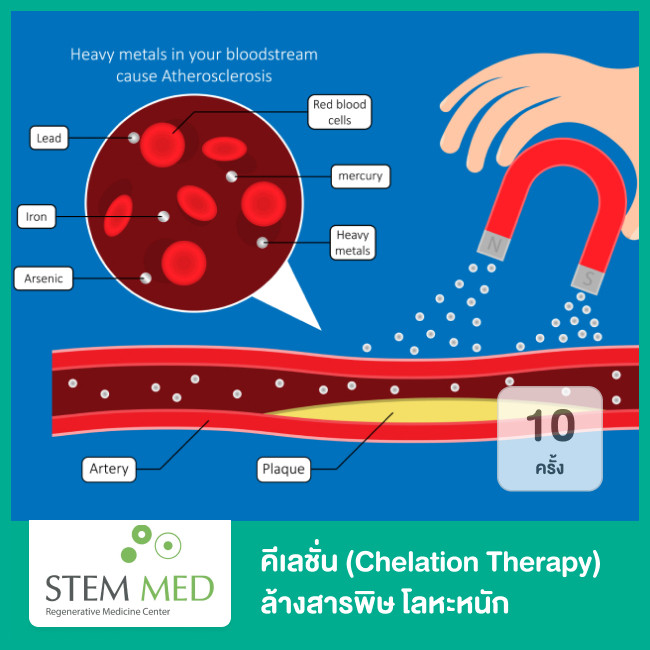 คีเลชั่น (Chelation Therapy) ล้างสารพิษ โลหะหนัก ในหลอดเลือด 10 ครั้ง ...