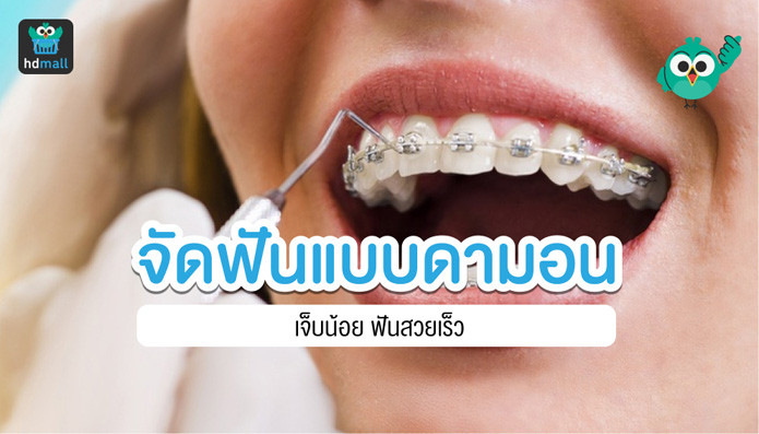 การจัดฟันแบบดามอน คืออะไร ข้อดีข้อเสียเป็นอย่างไร? | Hdmall