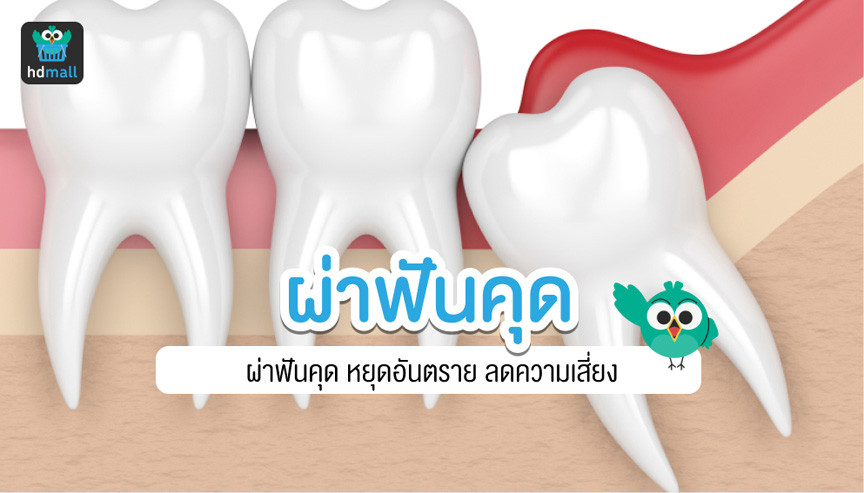 ผ่าฟันคุด เจ็บไหม กี่วันหาย ผ่าตอนไหน? อ่านสรุปที่นี่ | Hdmall