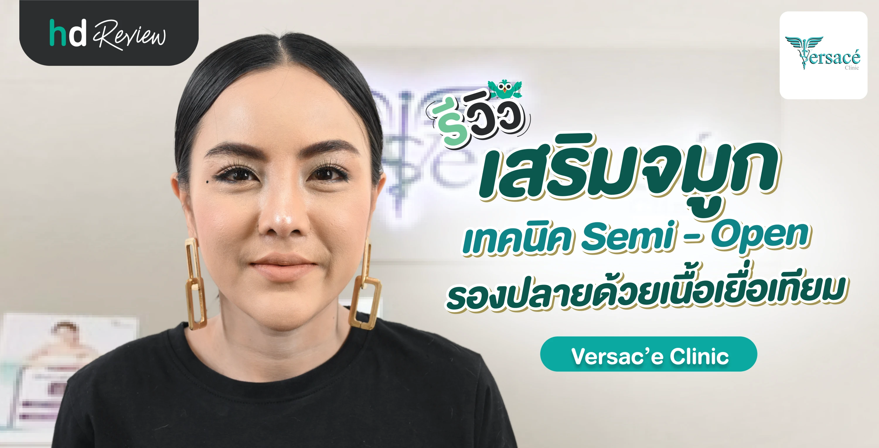 รีวิวเสริมจมูกเทคนิค Semi-Open รองปลายด้วยเนื้อเยื่อเทียม ที่ Versac'E  Clinic | Hdmall