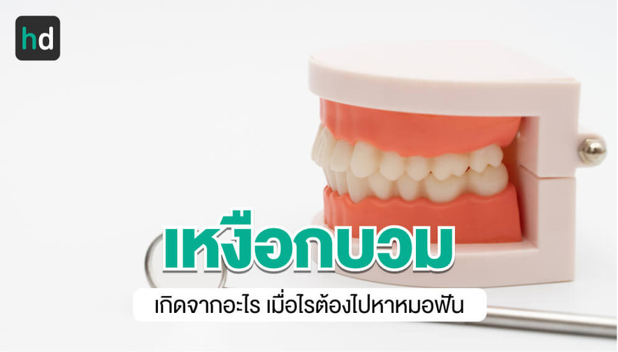 เหงือกบวม สาเหตุคืออะไร? รักษาด้วยตัวเองได้ไหม อย่างไร? | Hdmall