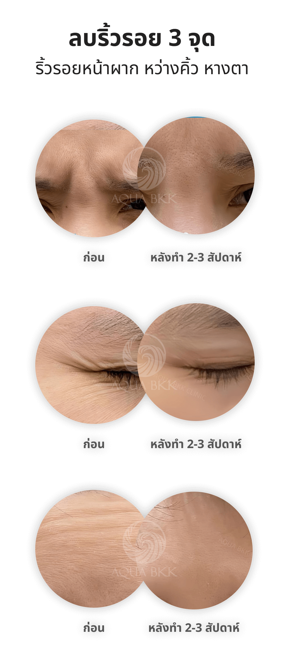 รีดริ้วรอยให้เรียบเนียน