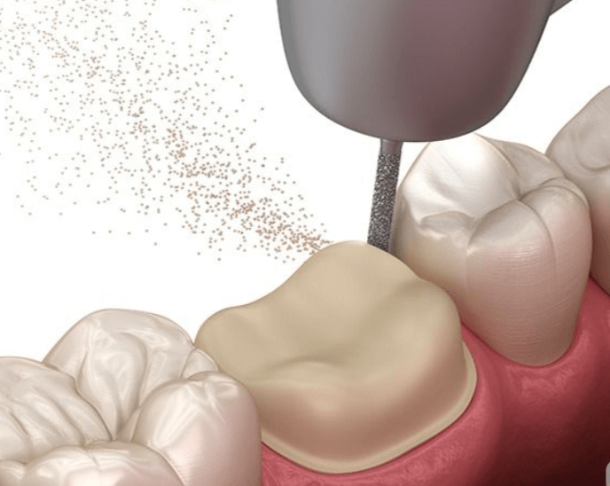 ขูดหินปูน