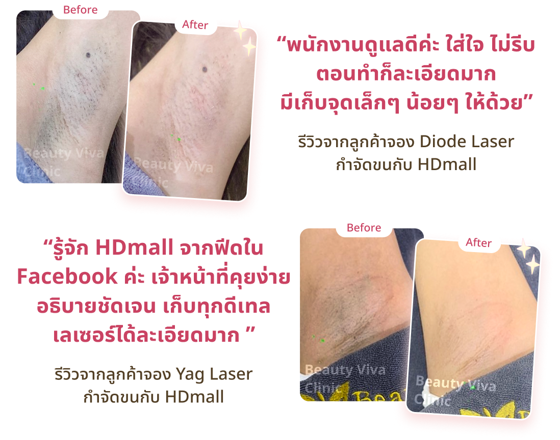 รีวิวผิวเนียนไร้ขน