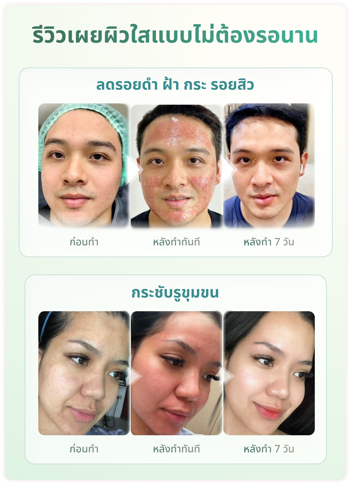 ผิวไม่เนียน เป็นหลุม ไม่ใช่ปัญหา